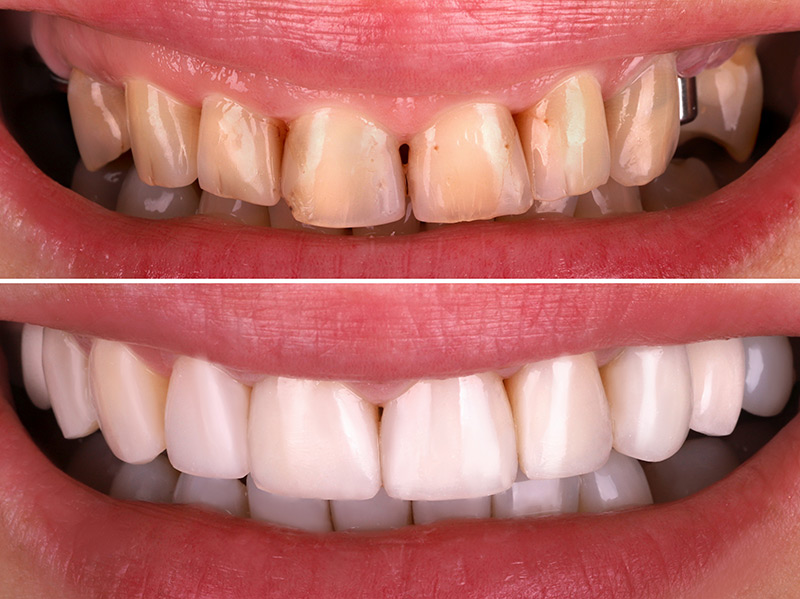 Restorative Dentistry Treatment Options